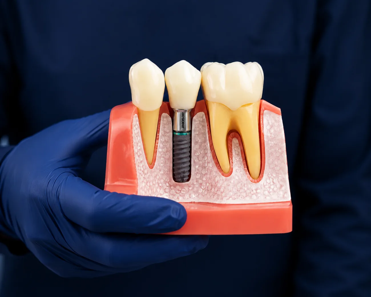 Implante dentário em detalhe na Akaki